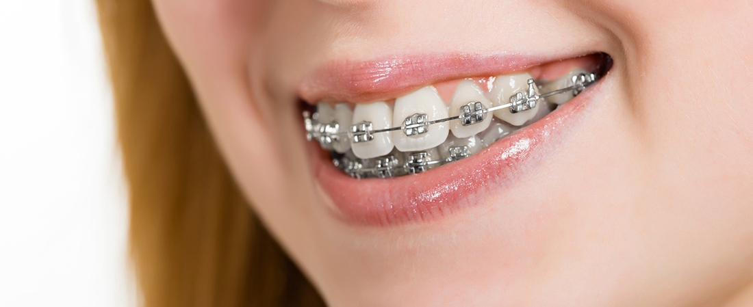 Components of Braces