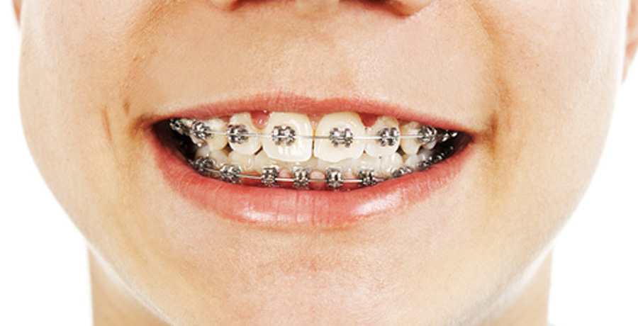 Best Time for a Child to See an Orthodontist