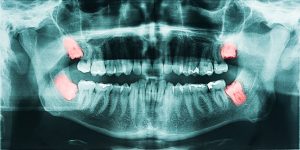 Wisdom Teeth